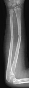 Figure 3_1387839-diaphysis_complete fracture_AP_0001.JPG